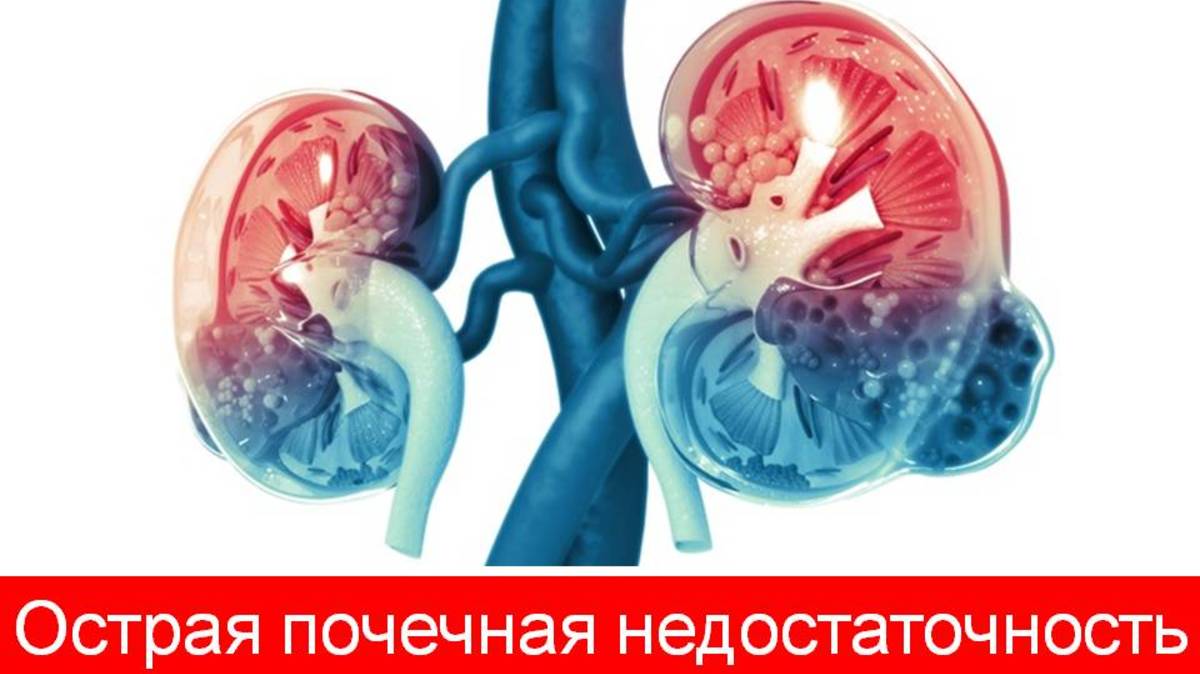 Острая почечная недостаточность. Часть 1. Причины и условия возникновения.