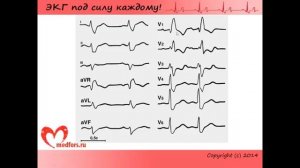 Урок 7. Видеокурс 'ЭКГ под силу каждому'.