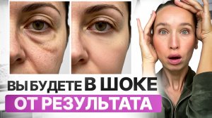 +12 лет к возрасту, морщины и мешки под глазами, дряблое веко, отёки и всё из-за ЭТИХ мышц