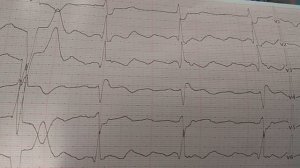 ТРЕПЕТАНИЕ ПРЕДСЕРДИЙ