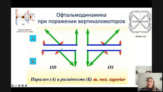 Диагностика паралитического косоглазия. Первичный прием