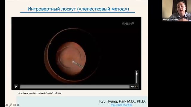 Оперативное лечение макулярных разрывов. От сложного  к простому