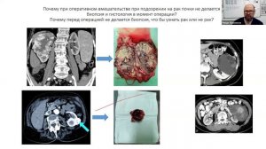 Хирургическое лечение рака почки. Ответы на вопросы (Леоненков Р.В.)