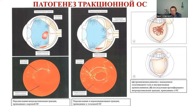 Отслойка сетчатки. Витреоретинальная хирургия