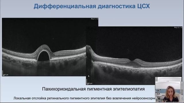 Центральная серозная хориоретинопатия