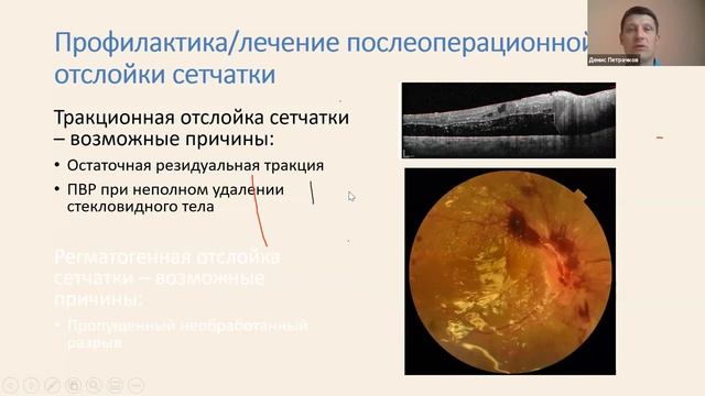 Хирургическое лечение пациентов с ПДР. Щадящая хирургия