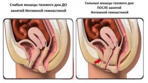 После операции на #опущение #недержание #гинекология #женскоездоровье