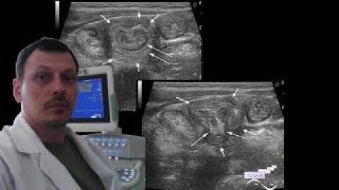 Детское УЗИ кишечника - Конгломерат в правой подвздошной области смотреть онлайн