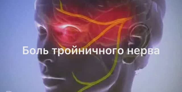 Невралгия тройничного нерва смотреть онлайн