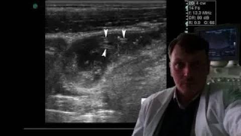 Детское УЗИ кишечника - Чужой на УЗИ (глист - аскарида) смотреть онлайн