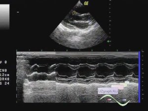 Лекция: Эхокардиография (УЗИ сердца). Базовый уровень.