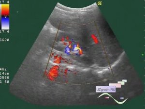 Лекция: УЗИ почек и мочевого пузыря. Базовый уровень
