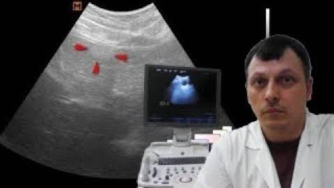 Детское УЗИ брюшной полости - Псевдоопухоль печени смотреть онлайн