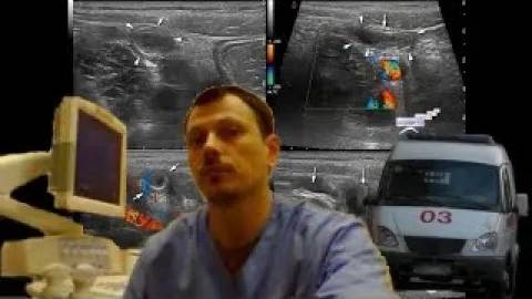 Детское УЗИ кишечника - Острый аппендицит, тифлит смотреть онлайн