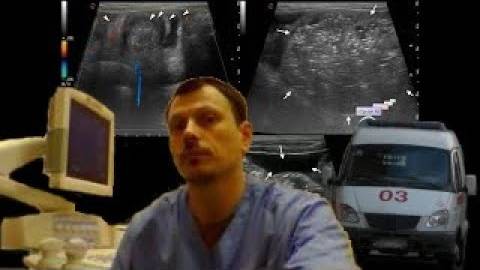 Детское УЗИ кишечника - Кишечная инвагинация, кишечная непроходимость, асцит смотреть онлайн