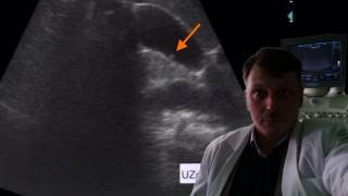 УЗИ брюшной полости - Полип желчного пузыря смотреть онлайн