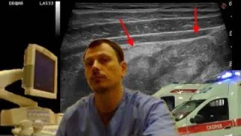 Детское УЗИ кишечника - Ушиб кишечника смотреть онлайн