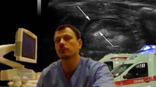 Детское УЗИ кишечника - Локальное утолщение стенки толстой кишки смотреть онлайн