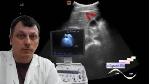 Детское УЗИ брюшной полости - Удвоение желчного пузыря смотреть онлайн