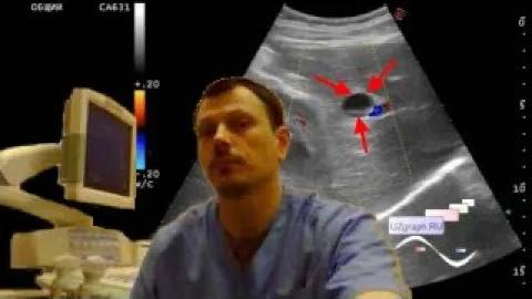 Детское УЗИ брюшной полости - Агенезия желчного пузыря, киста холедоха смотреть онлайн