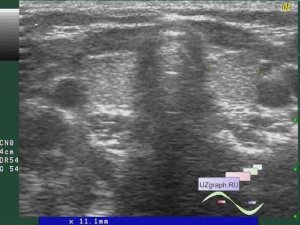 Лекция: УЗИ щитовидной железы. Базовый уровень