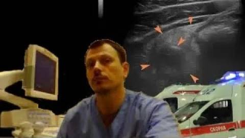 Детское УЗИ брюшной полости - Классический аппендикулярный инфильтрат смотреть онлайн