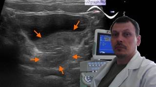 Детское УЗИ кишечника - Долихосигма смотреть онлайн