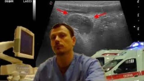 Детское УЗИ кишечника - Острый аппендицит / периаппендикулярный инфильтрат смотреть онлайн