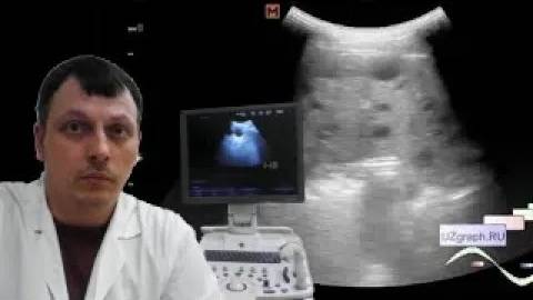Детское УЗИ селезенки - Диффузно-очаговые изменения селезенки смотреть онлайн
