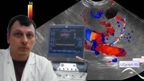 Детское УЗИ селезенки - Киста селезенки смотреть онлайн