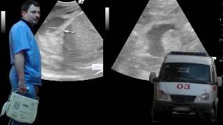 Детское УЗИ брюшной полости - Осумкованная жидкость поддиафрагмальном пространстве смотреть онлайн