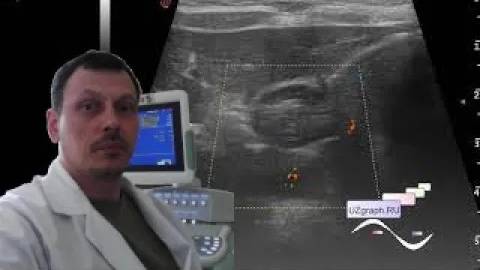 Детское УЗИ желудка - Пилороспазм смотреть онлайн