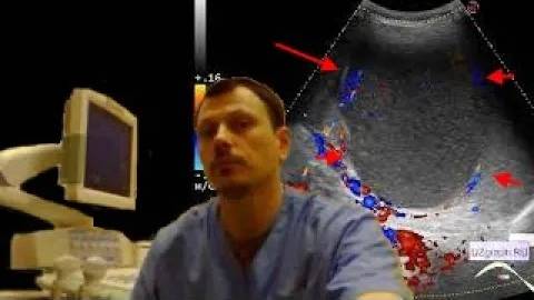 Детское УЗИ селезенки - Гигантская киста селезенки смотреть онлайн