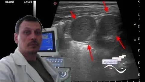 Детское УЗИ селезенки - Полиспления, доля Риделя смотреть онлайн