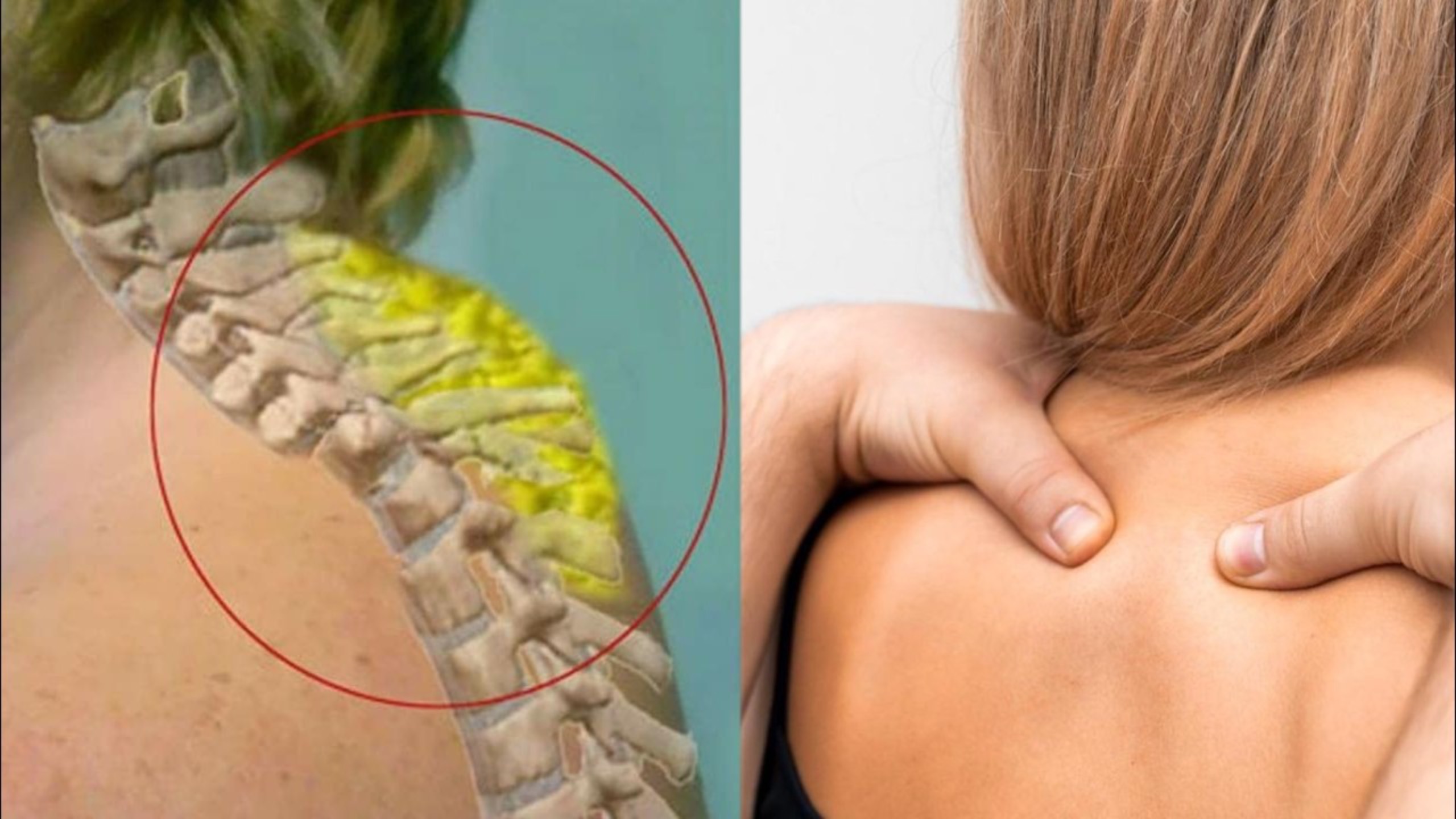 Шок результат! Это упражнение от холки даю только своим пациентам! Как убрать холку навсегда?