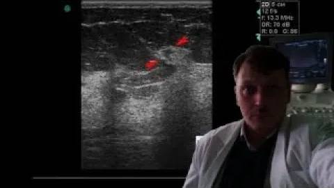 УЗИ молочных желез - Образование по типу звезды смотреть онлайн