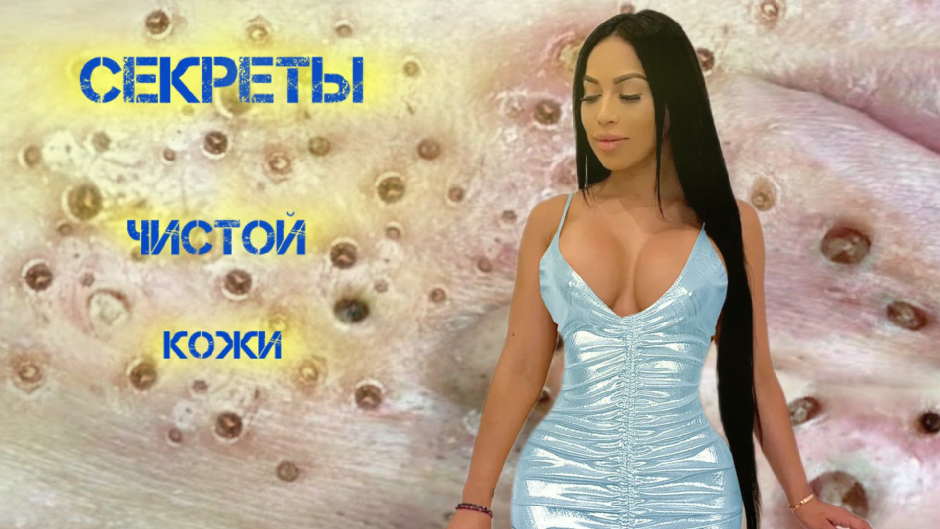 Самые Жирные и Вонючие прыщи Угри и Акне ! смотреть онлайн