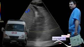 Детское УЗИ легких - Ателектаз легкого ... смотреть онлайн