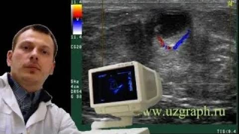 Детское УЗИ молочных желез - Киста с воспалением (подострый мастит) смотреть онлайн