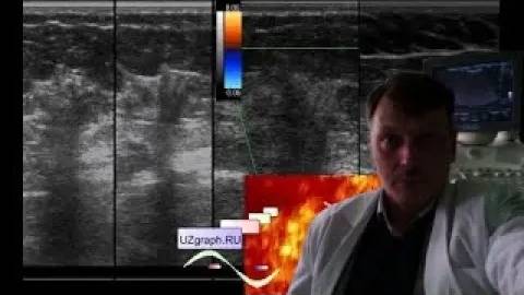 УЗИ молочных желез - Birads 4-5 смотреть онлайн