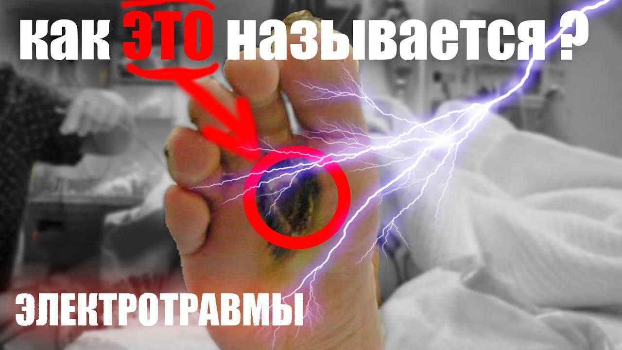 Электрический ток поражает, или Какие бывают электротравмы