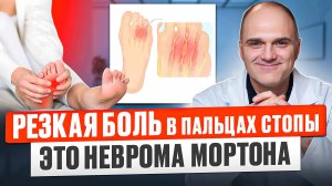 Как лечить неврому Мотрона. Что такое неврома Мортона и как ее диагностировать