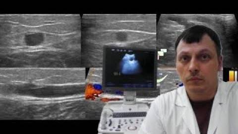 Детское УЗИ сосудов (УЗДГ) - Варикозная болезнь вен нижних конечностей смотреть онлайн