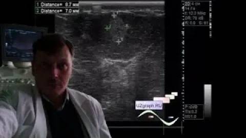 УЗИ молочных желез - Образование молочной железы смотреть онлайн