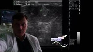 УЗИ молочных желез - Образование молочной железы