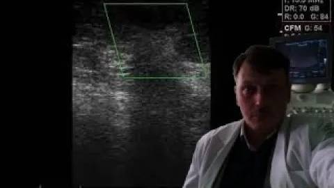 УЗИ молочных желез - Би-радс 4-5 смотреть онлайн