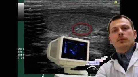 Детское УЗИ щитовидной железы - Область щитовидной железы с гиперэхогенными точечными включениями смотреть онлайн