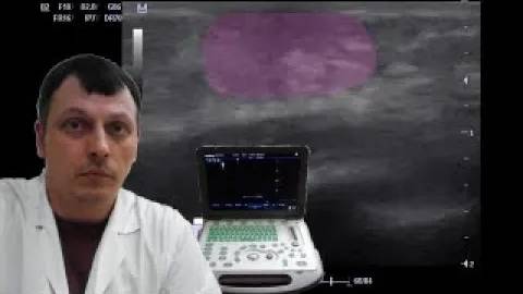 Детское УЗИ молочных желез - Изолированное телархе у грудничка смотреть онлайн