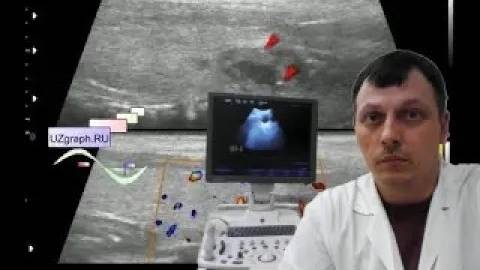 Детское УЗИ щитовидной железы - Кистозно-солидный узел щитовидки смотреть онлайн