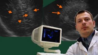 Нейросонография - Повышение перивентрикулярной эхогенности смотреть онлайн